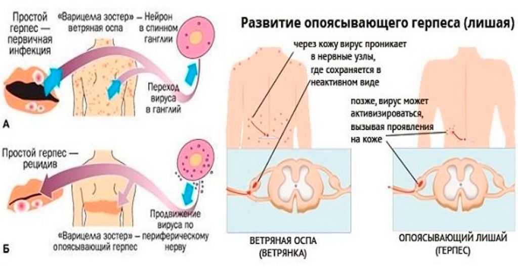 Как лечить вирус герпеса на ногах