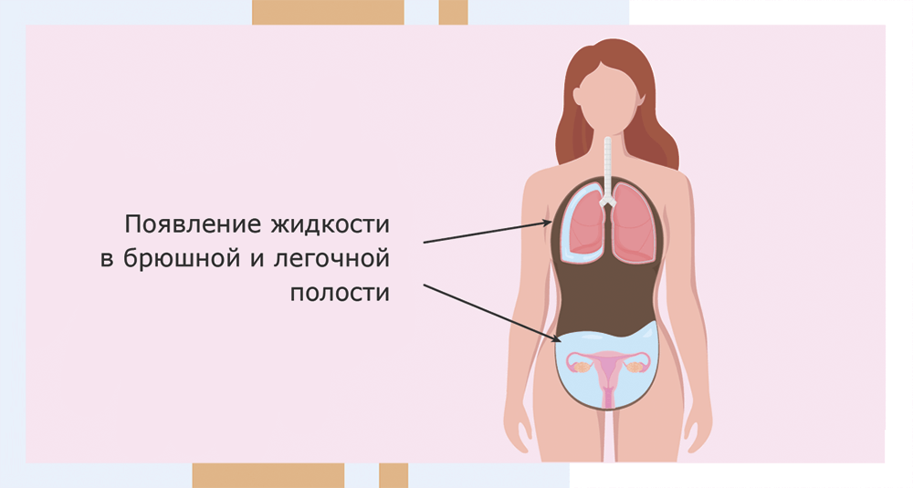 Синдром гиперстимуляции яичников при эко