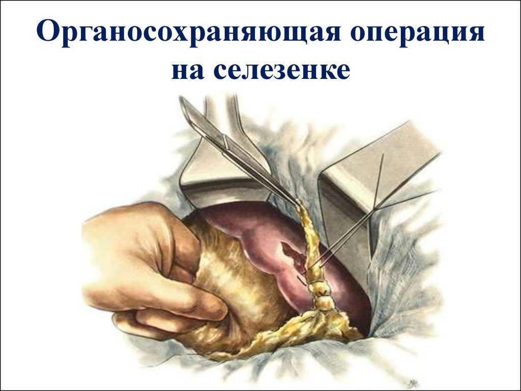 Спленэктомия (удаление селезенки): показания, как проводится, реабилитация и последствия