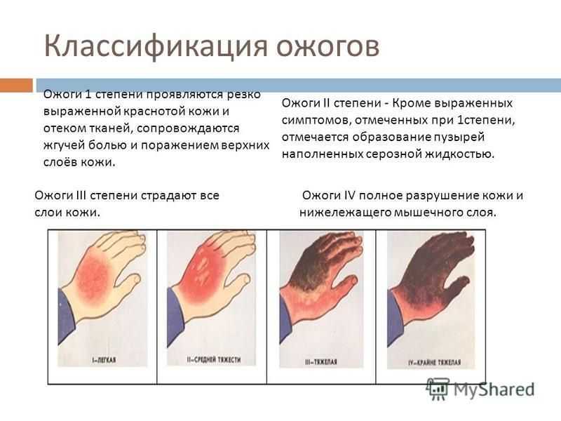 Тяжелые ожоги