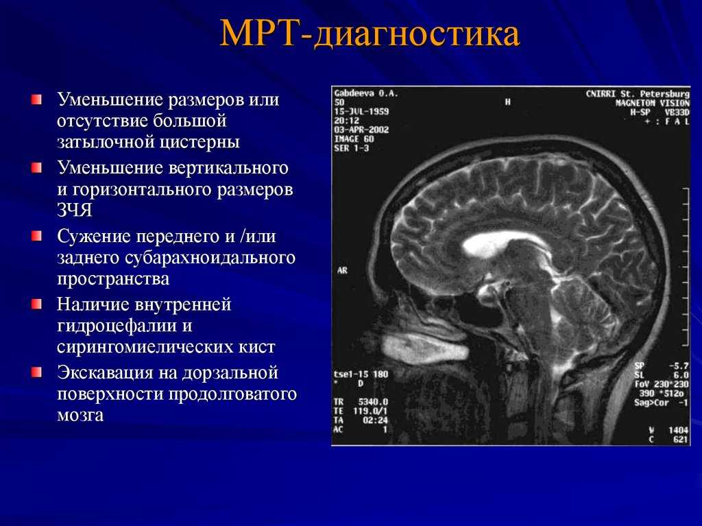 Расширение субарахноидальных пространств головного мозга у взрослых