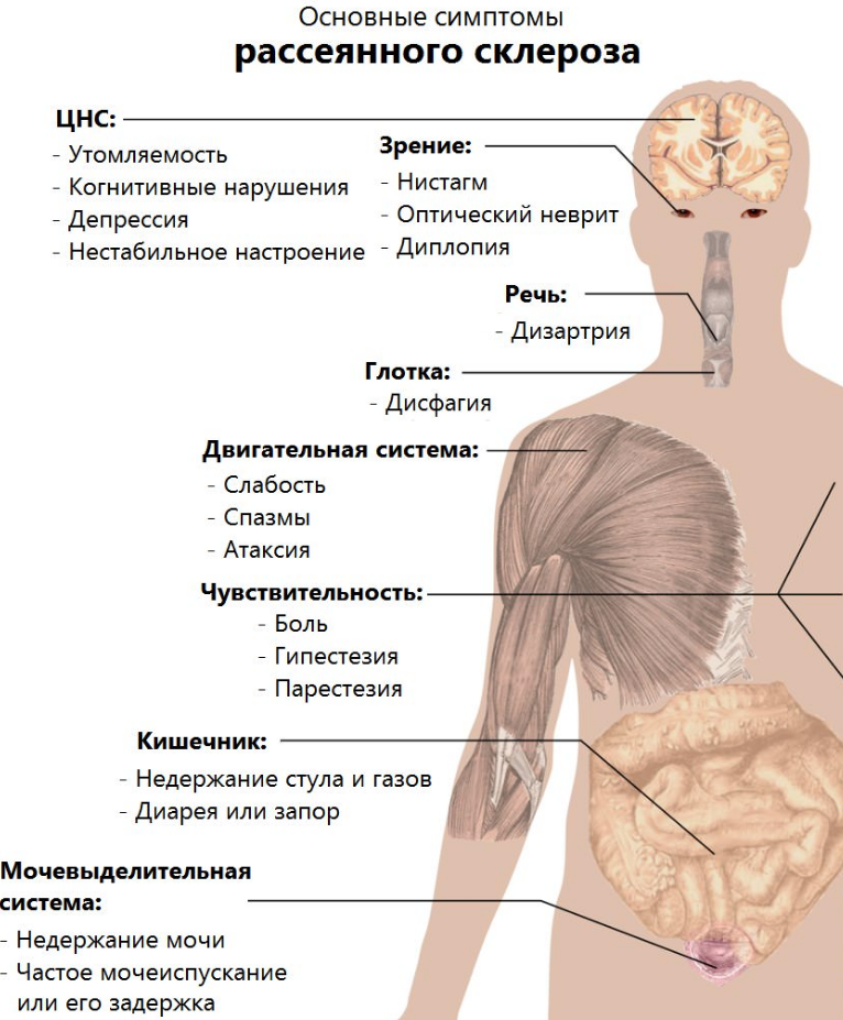 Сколько можно прожить с рассеянным склерозом