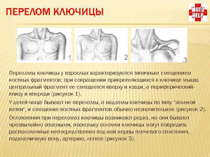 Открытый и закрытый перелом ключицы со смещением, симптомы