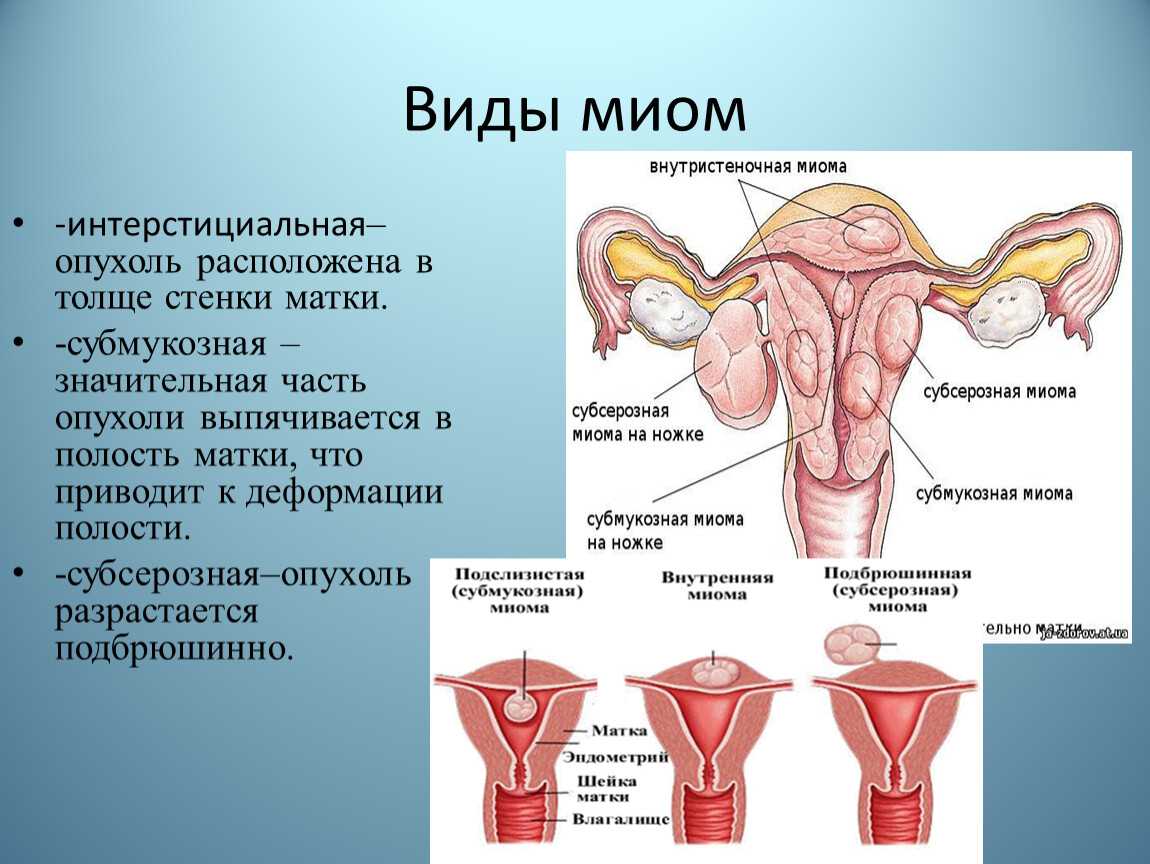 Удаление матки гистреэктомия: проблемы в отношениях и сексе