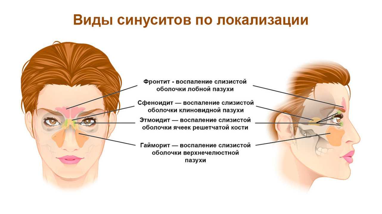 Воспаление носовых пазух: синуситы, гаймориты, фронтиты - симптомы и лечение у детей и взрослых