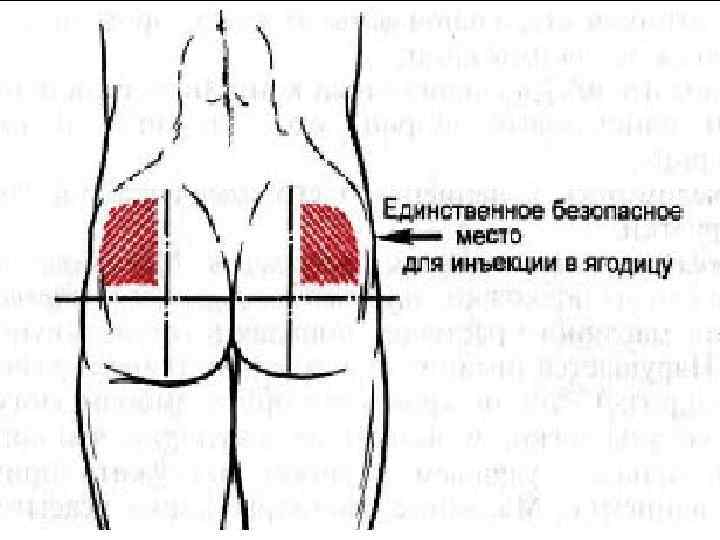 Как научиться ставить уколы внутримышечно детям