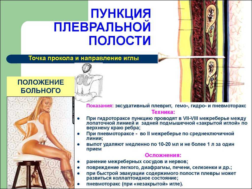 Плевральная пункция - описание услуги, при каких болезнях и какие врачи назначают