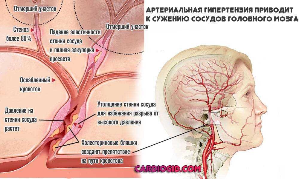Диабетическая кома