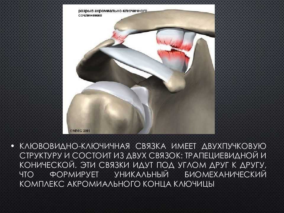 Разрыв акромиально ключичного сочленения - от симптомов до лечения