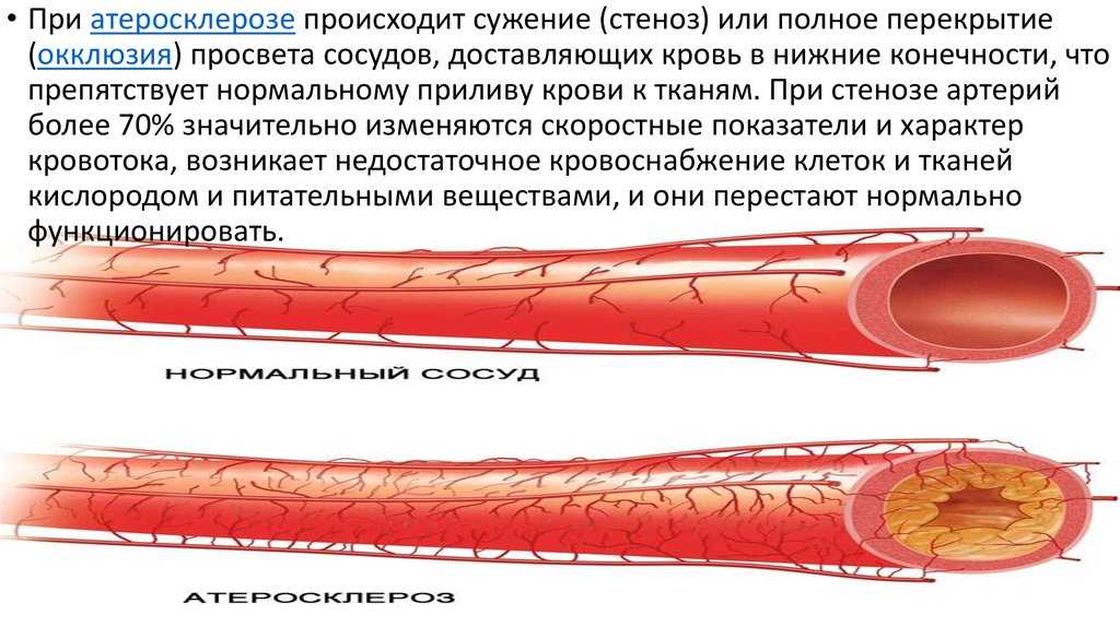 Атеросклероз: понятие, как развивается, симптомы и течение, лечение, осложнения