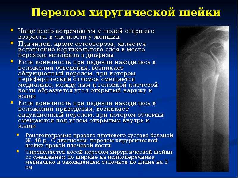 Переломы хирургической шейки плеча: симптомы, первая помощь