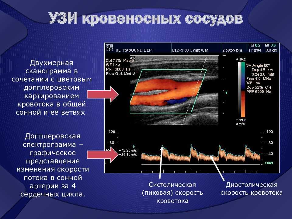 Узи шеи и головы сосудов что показывает и как делают узи сосудов шеи и головы