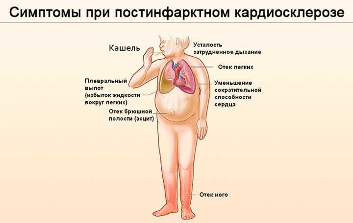 Атеросклеротический кардиосклероз: причины, симптомы и лечение