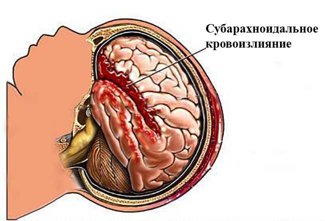 Признаки субарахноидального кровоизлияния в головной мозг
