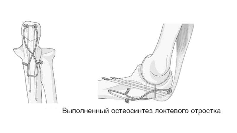 Перелом локтевого отростка локтевой кости: операция и лечение переломов со смещением