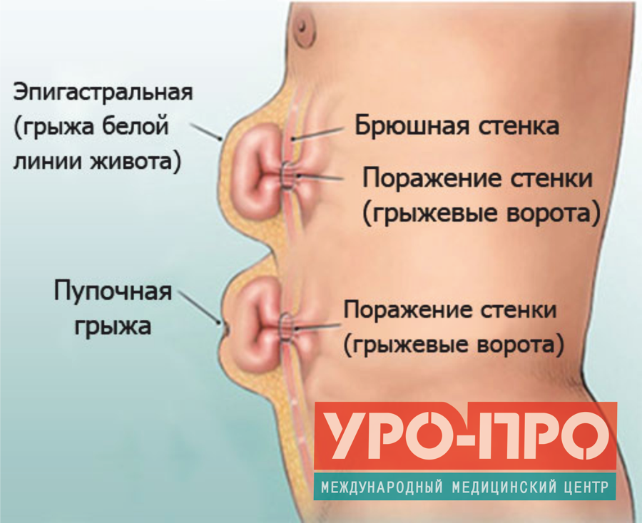 Диагностика и лечение пупочной грыжи во время беременности