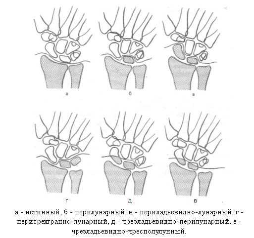 Вывих фаланги пальца на руке или ноге: как правильно лечить?