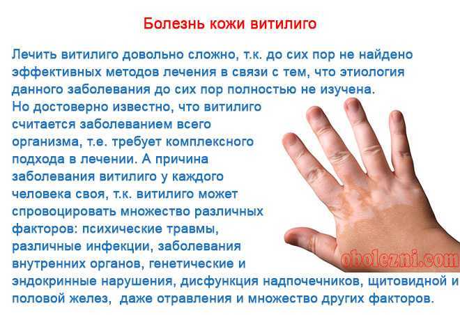 Можно ли загорать при витилиго