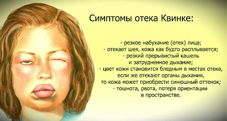 Рост аллергии или что делать