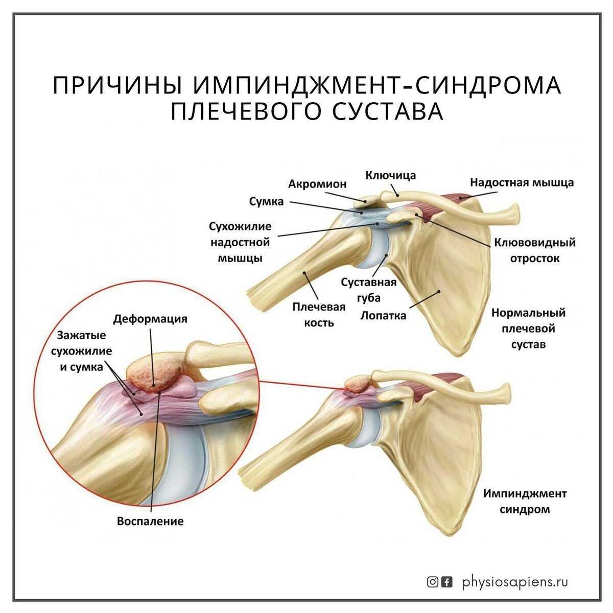 Импиджмент синдром голеностопного сустава | ortoped-klinik.com