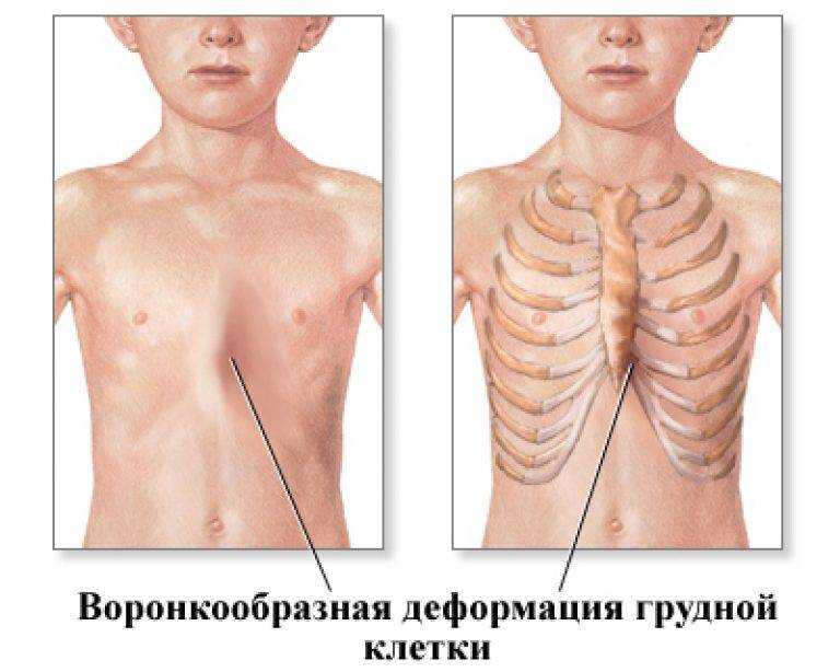 Деформации грудной клетки | сеть клиник «здравклиник»