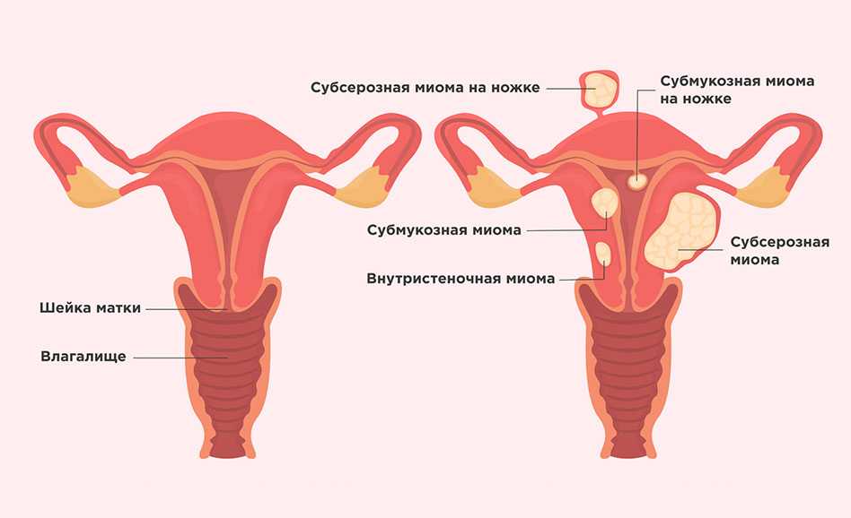 Гистерэктомия: виды, состояние после удаления матки, экстирпация матки, лапароскопия | клиники «евроонко»
