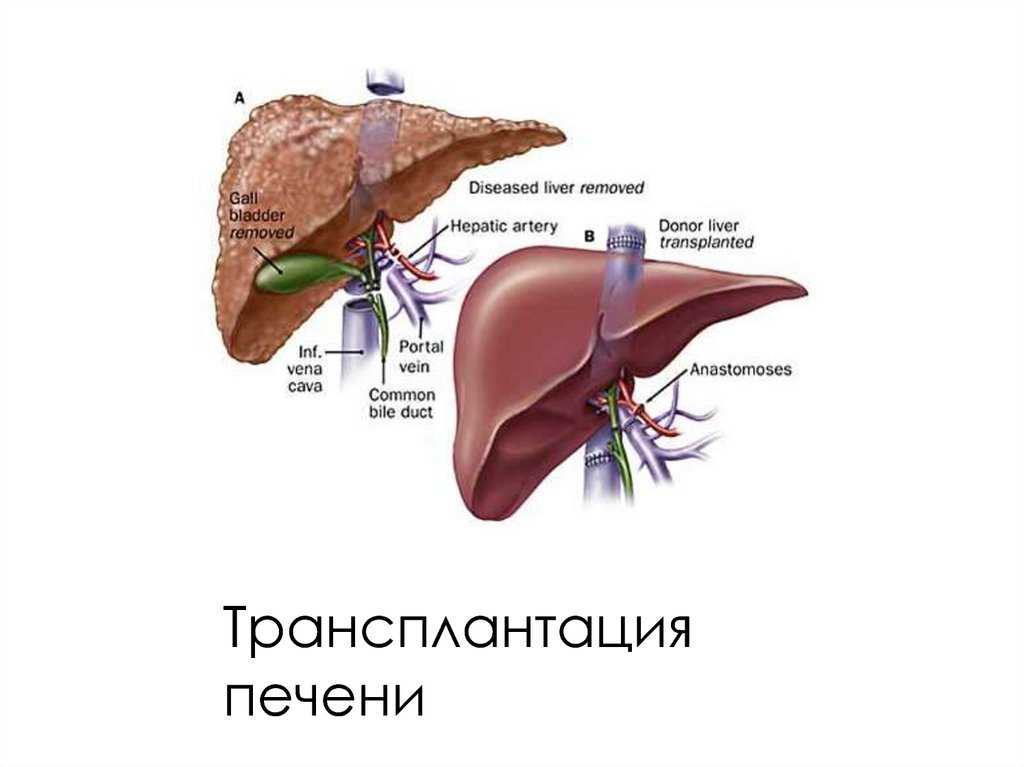 Пересадка печени: противопоказания, показания, последствия