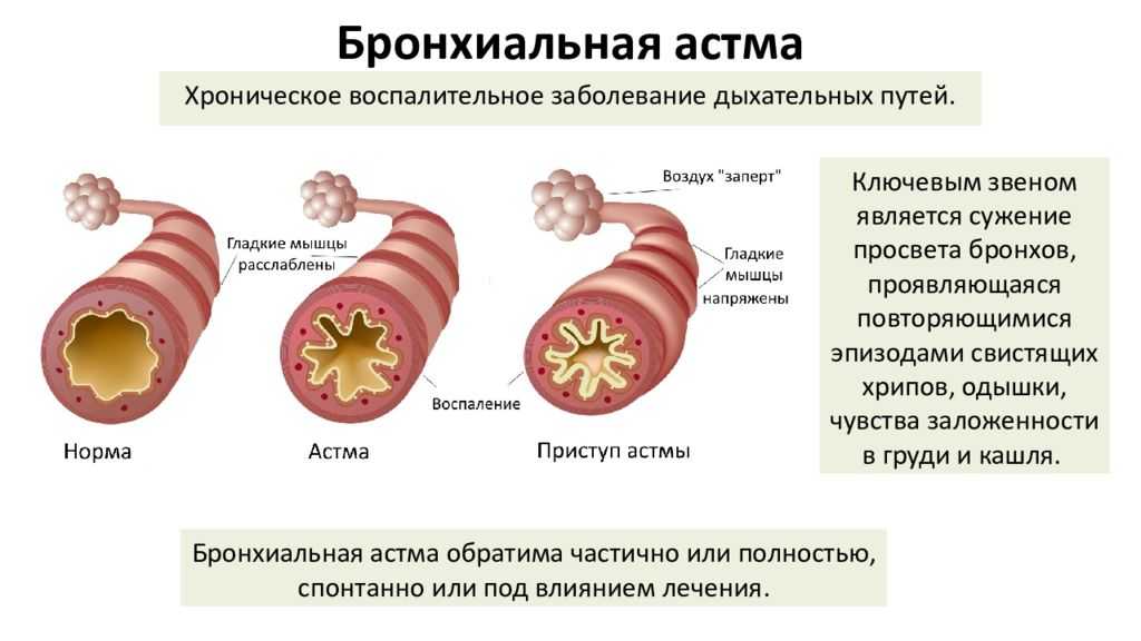 Бронхоспазм бронхиолоспазм, бронхоспастический синдром