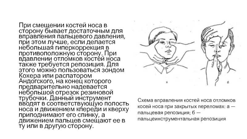 Признаки сломанного носа, как понять, что нос сломан