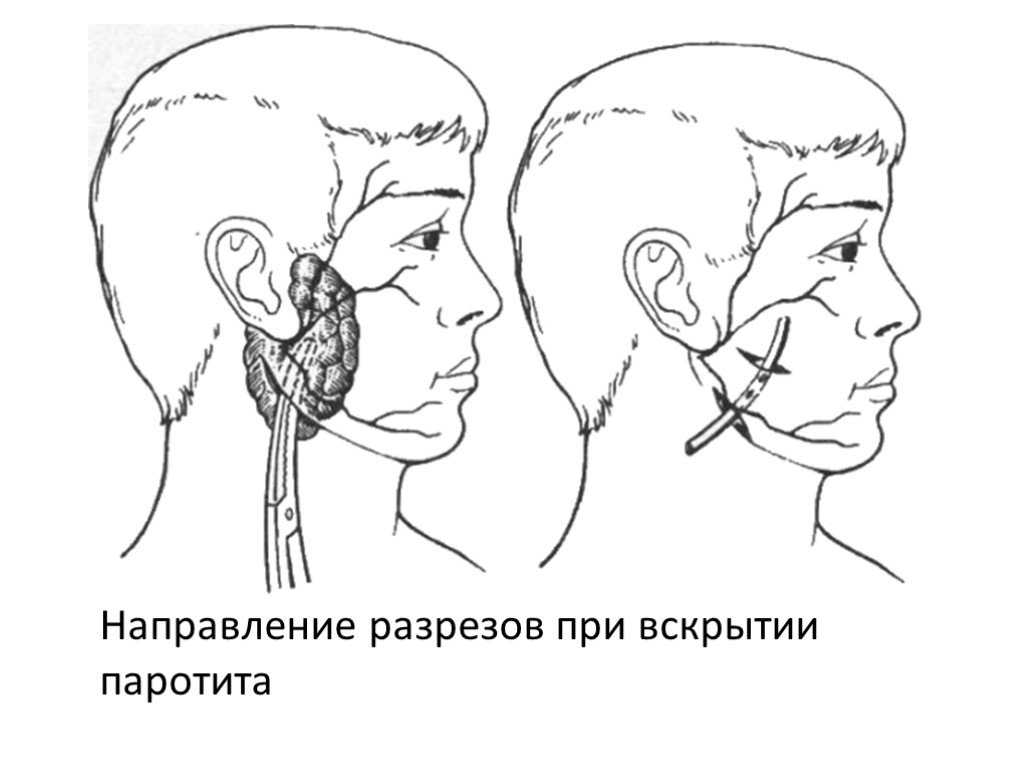 Калькулезное воспаление слюнных желез