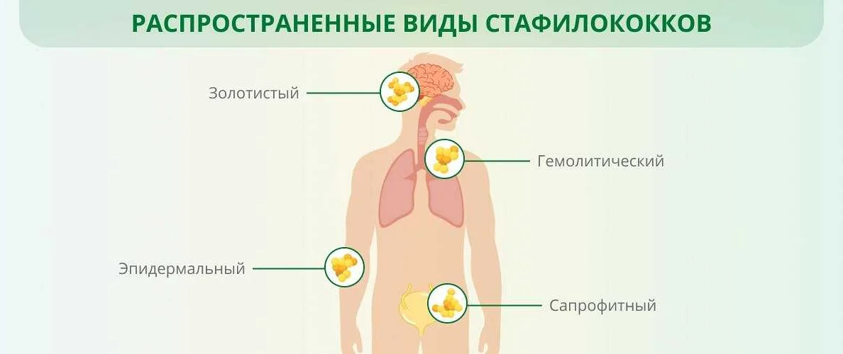 Золотистый стафилококк: симптомы, лечение, виды инфекции