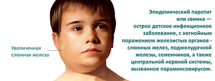 Эпидемический паротит (свинка): что это такое и как с этим бороться