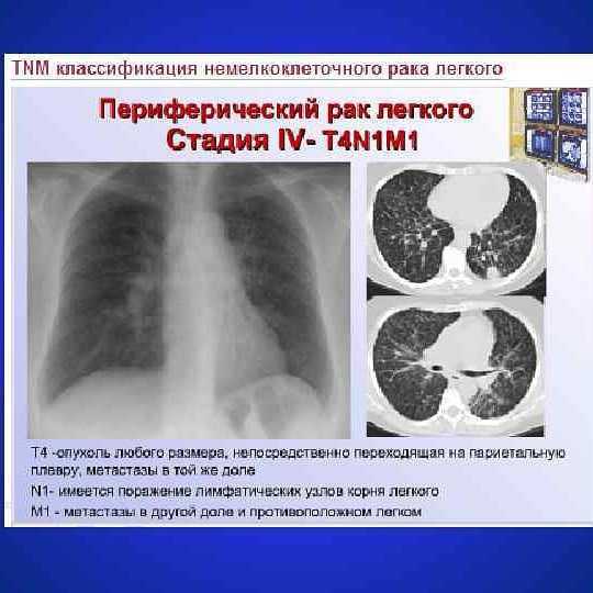 Сколько живут с раком легких? | первый медицинский центр тель-авива