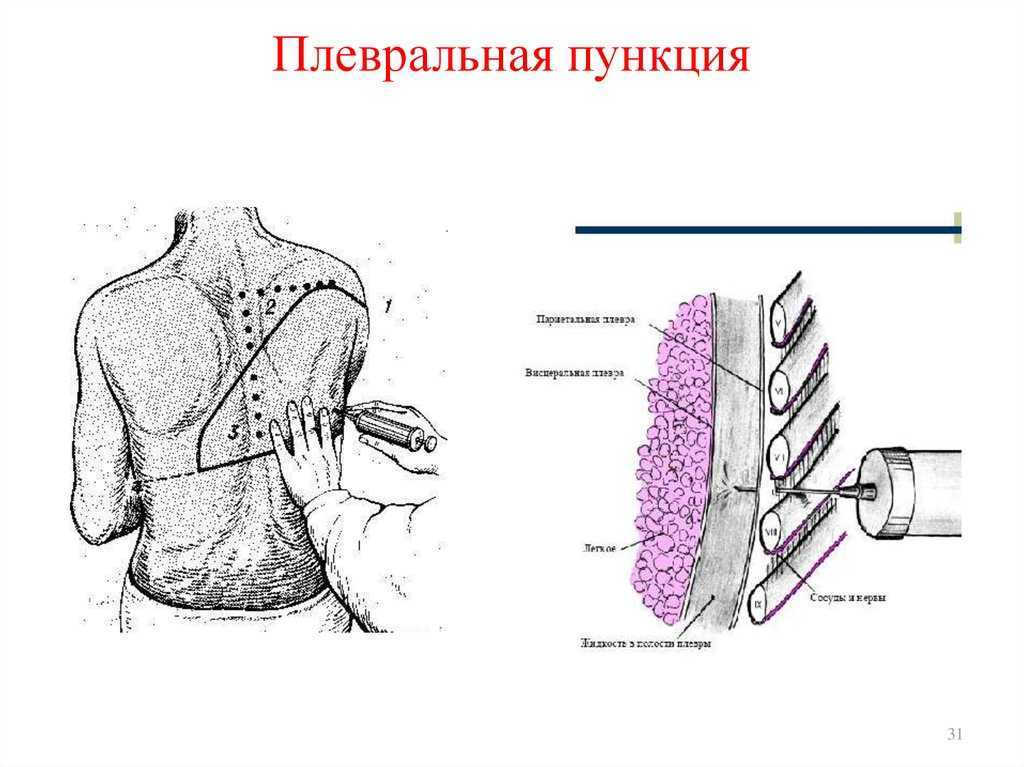 Техника проведения плевральной пункции - подготовка пациента к торакоцентезу