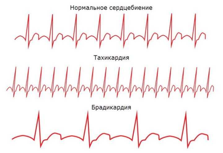 Брадикардия - понятие, формы, симптомы, лечение, разбор частных случаев