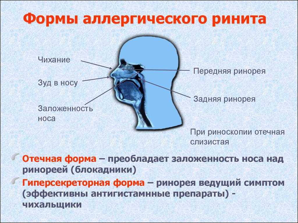Заразен ли насморк — симптомы инфекционного ринита